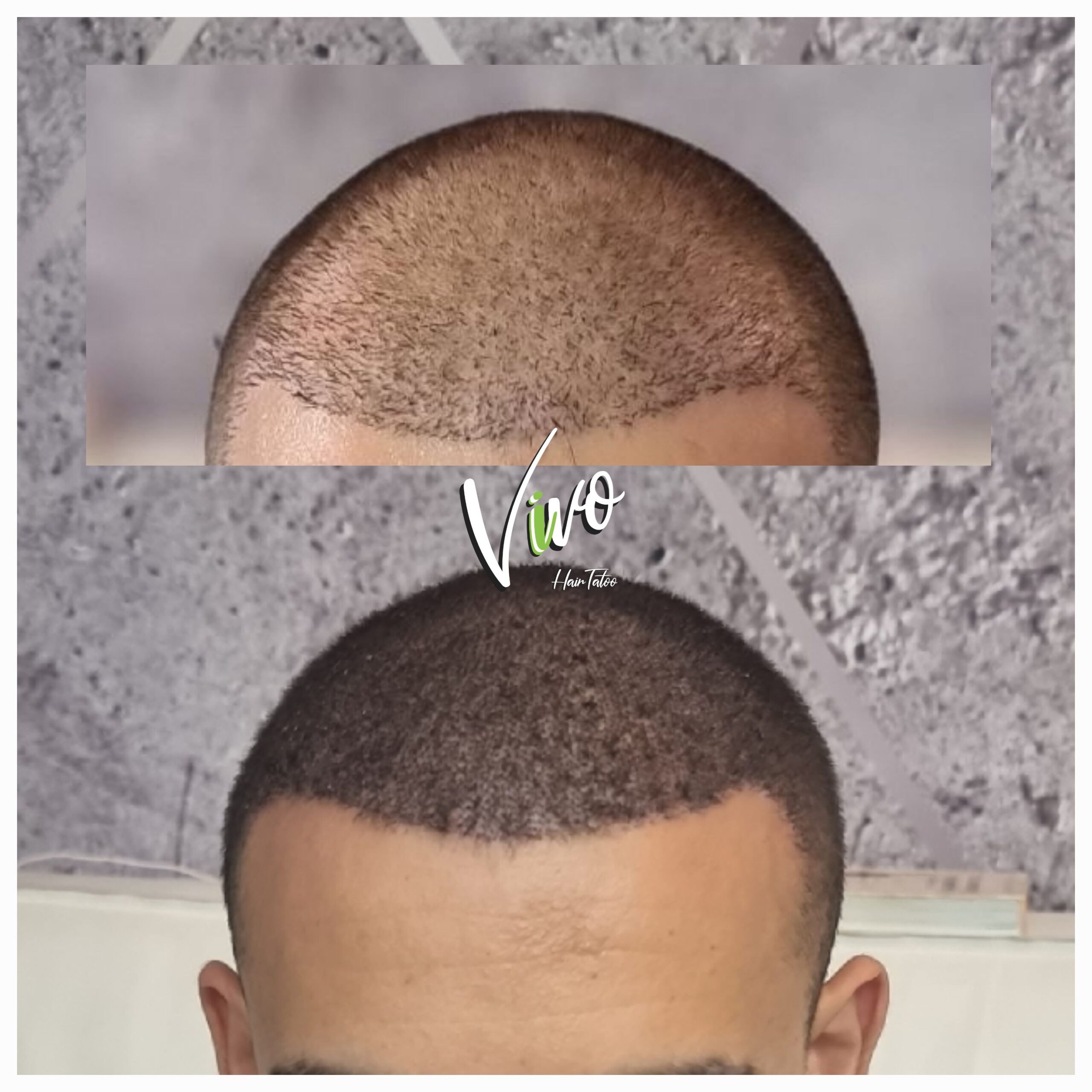 תוצאה לאחר הדמיית שיער אצל Vivo - מומחה לתיקון השתלות שיער