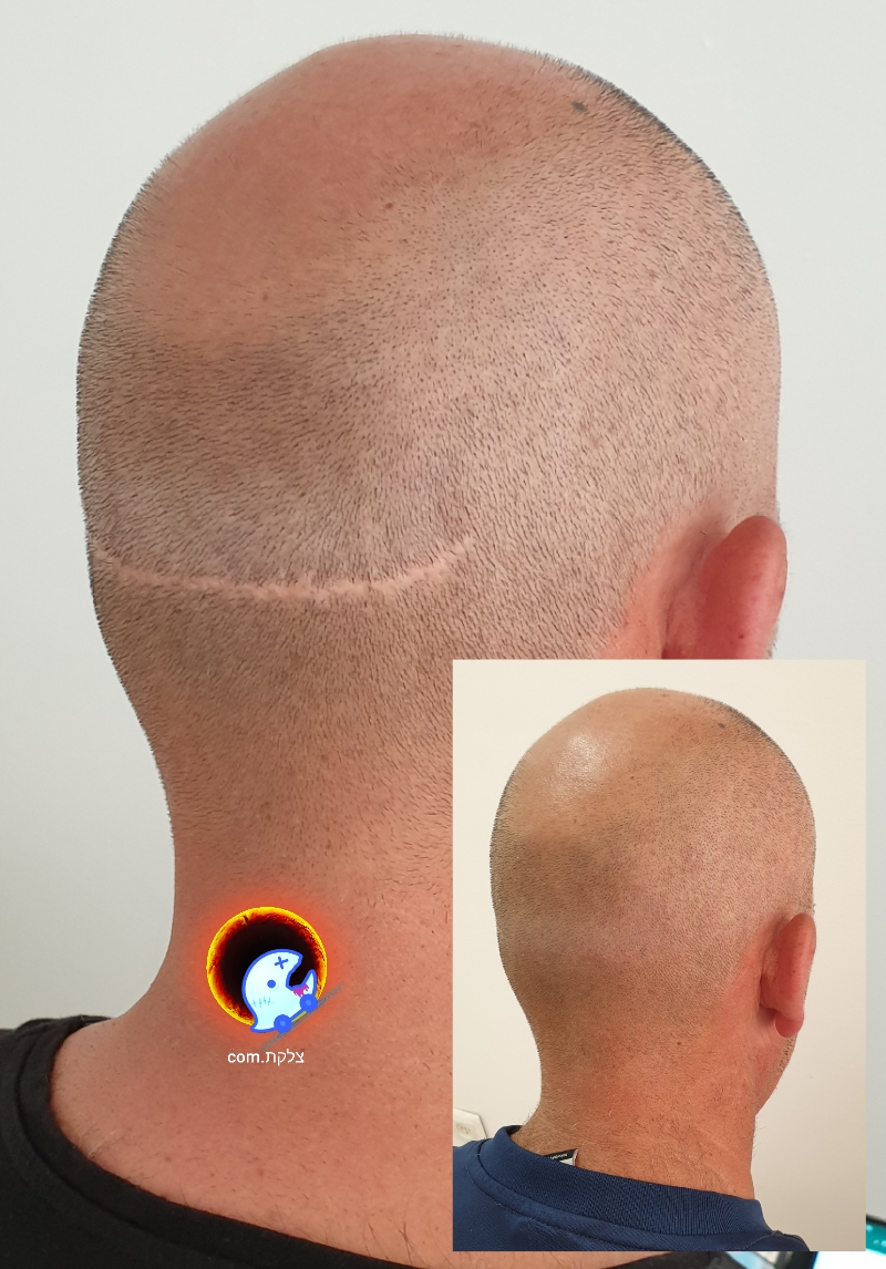 תיקון צלקת רצועה מהשתלת שיער