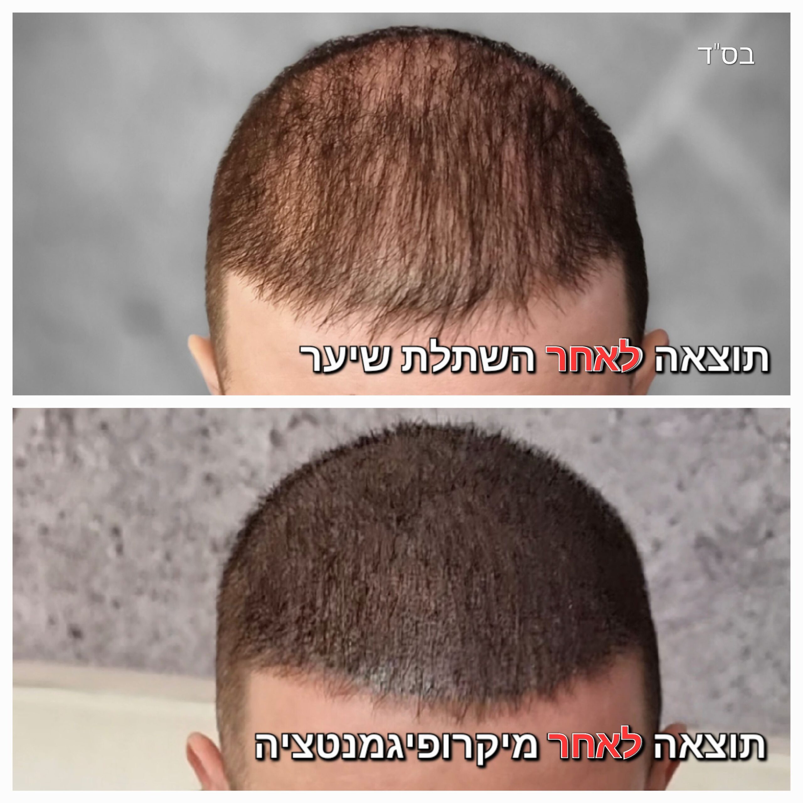 מילוי שיער לאחר השתלת שיער ע"י מיקרופיגמנטציה