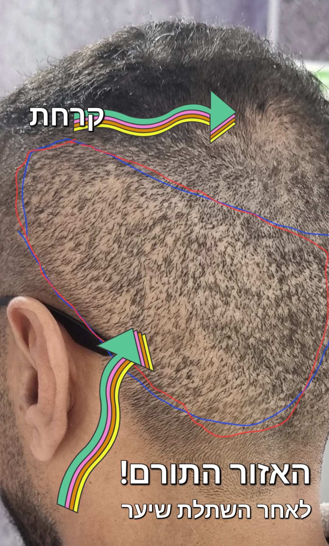 האזור התורם לאחר השתלת שיער - צלקות בעורף הראש