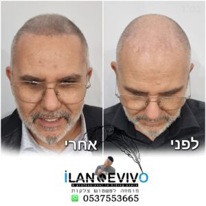 הדמיית שיער מיקרופיגמנטציה לגבר לפני ואחרי